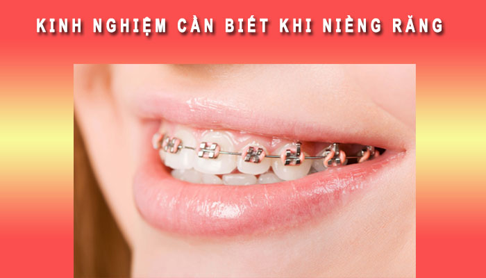 Kinh nghiệm khi niềng răng