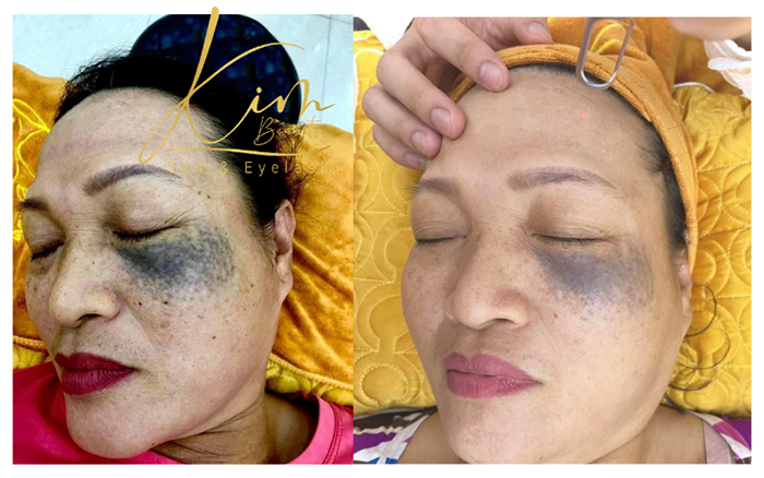 Điều trị nám tại Kim Beauty Spa