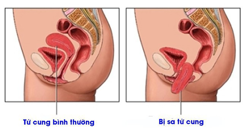 Phẫu thuật treo tử cung là gì? Có thực sự hiệu quả?
