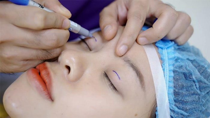 Chia sẻ kinh nghiệm cắt mí